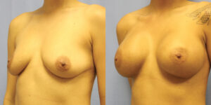 Patient 78b Breast Augmentation Before and After