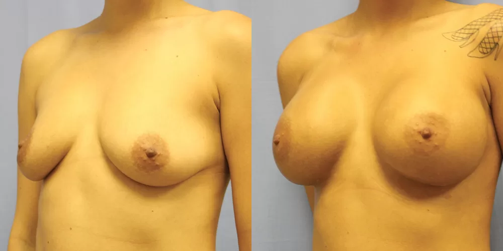 Patient 78b breast augmentation before and after