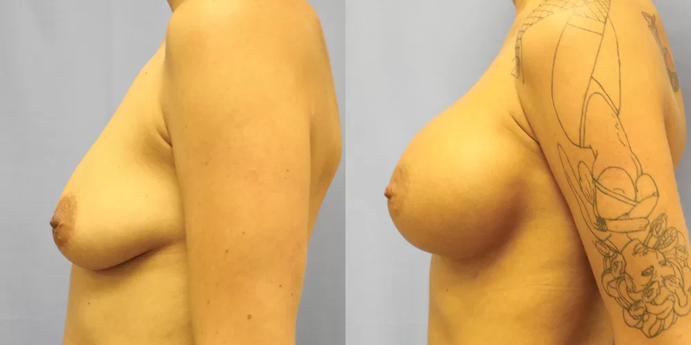 Patient 78c breast augmentation before and after