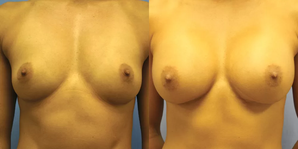 Patient 79a breast augmentation before and after