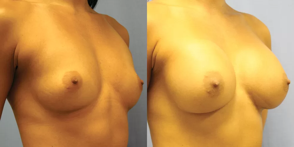 Patient 79b breast augmentation before and after