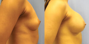Patient 79c Breast Augmentation Before and After