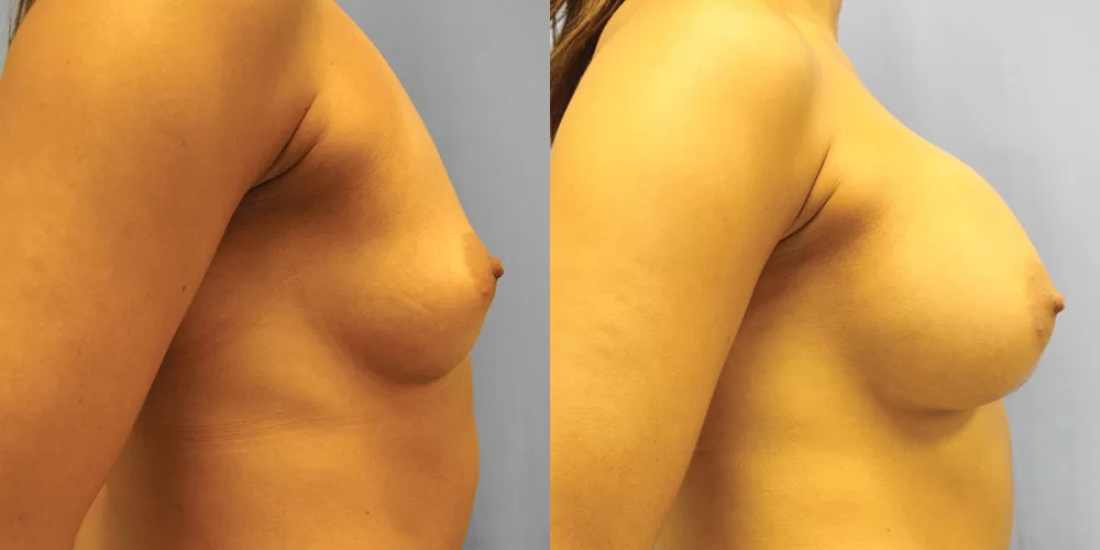 Patient 79c breast augmentation before and after