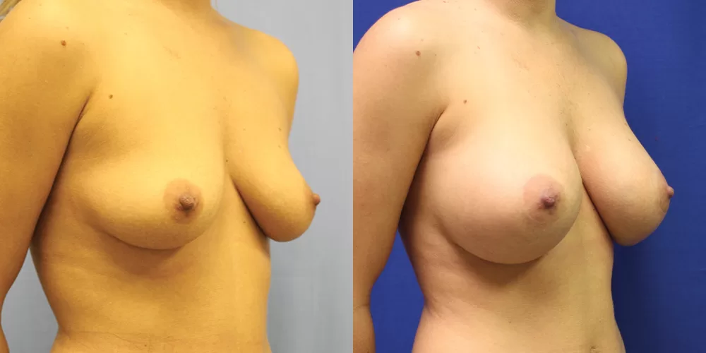 Patient 80b breast augmentation before and after