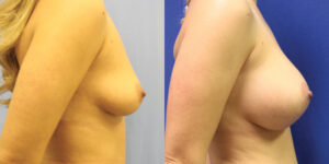 Patient 80c Breast Augmentation Before and After