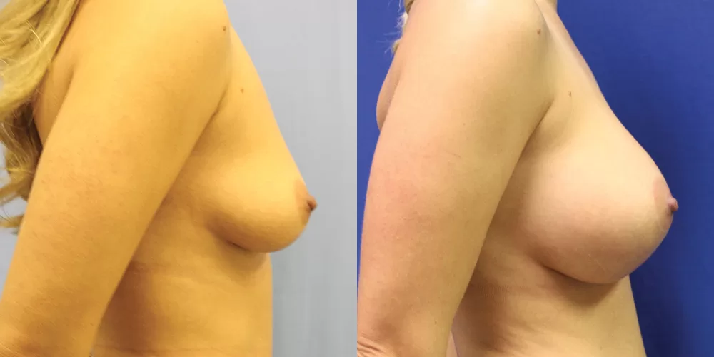 Patient 80c breast augmentation before and after