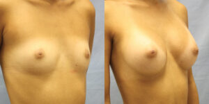 Patient 81b Breast Augmentation Before and After