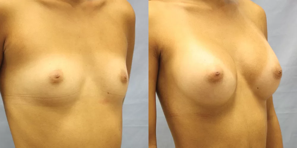 Patient 81b breast augmentation before and after