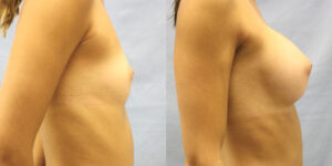 Patient 81c Breast Augmentation Before and After