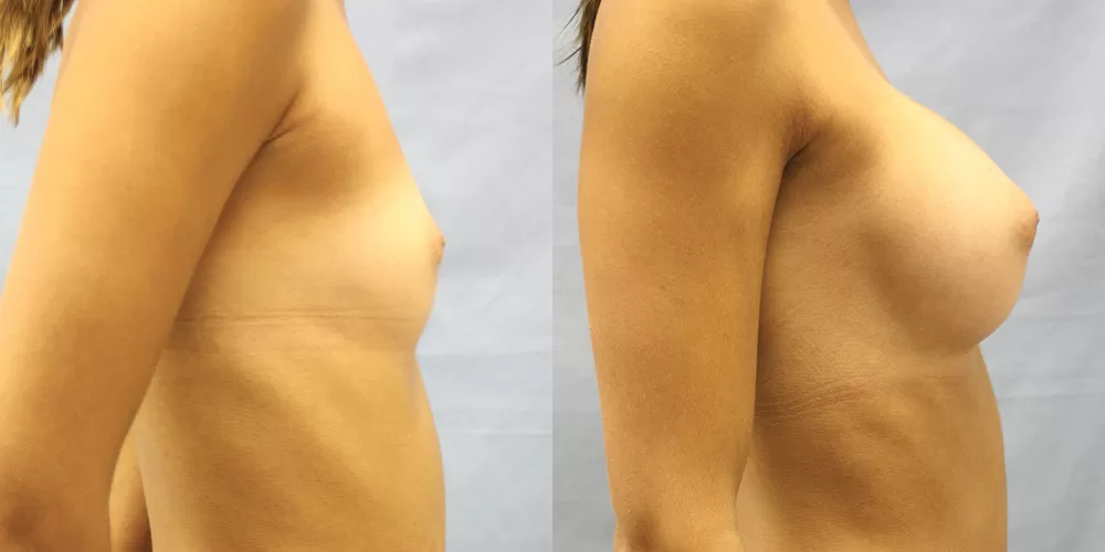 Patient 81c breast augmentation before and after