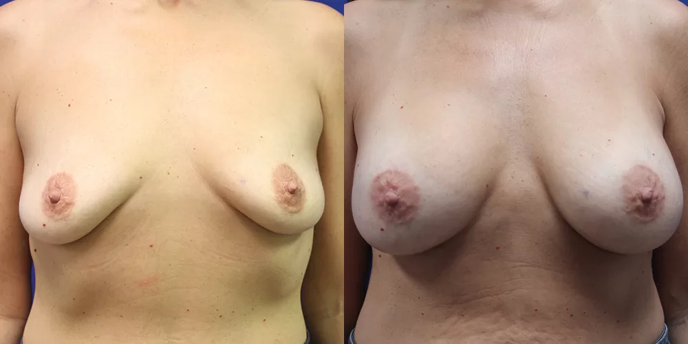 Patient 82a breast augmentation before and after