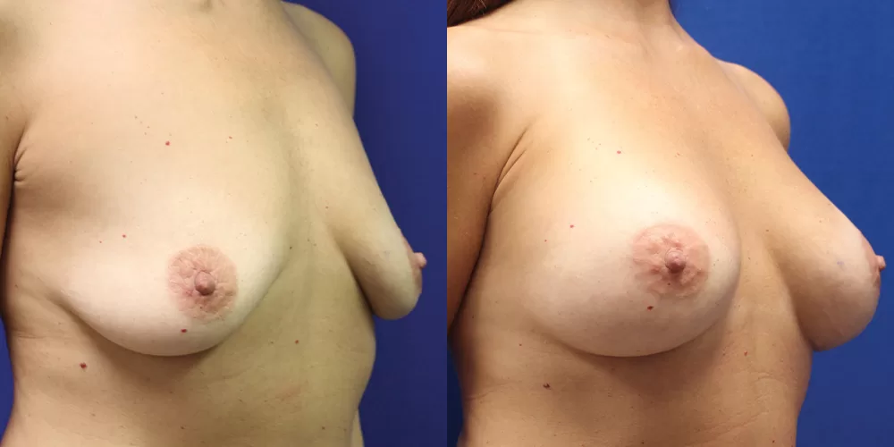Patient 82b breast augmentation before and after
