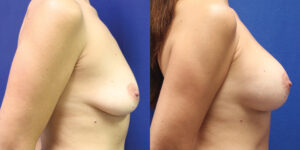 Patient 82c Breast Augmentation Before and After