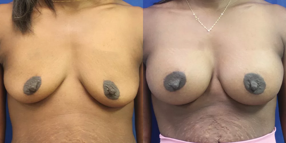 Patient 83a breast augmentation before and after
