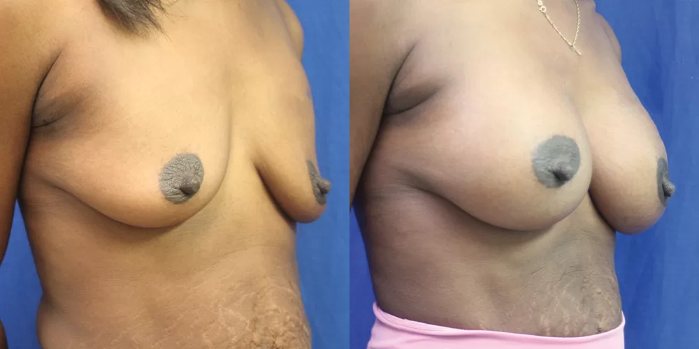 Patient 83b breast augmentation before and after