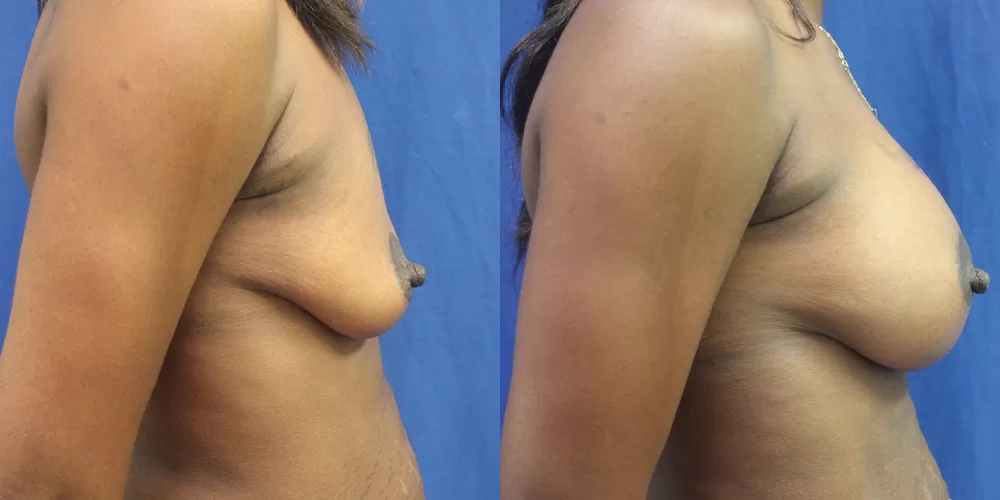 Patient 83c breast augmentation before and after