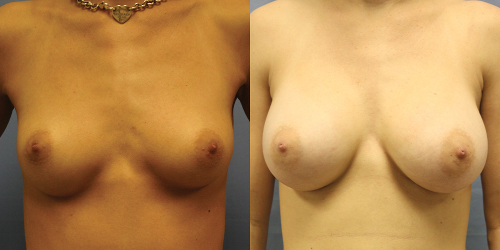 Patient 84a Breast Augmentation Before and After
