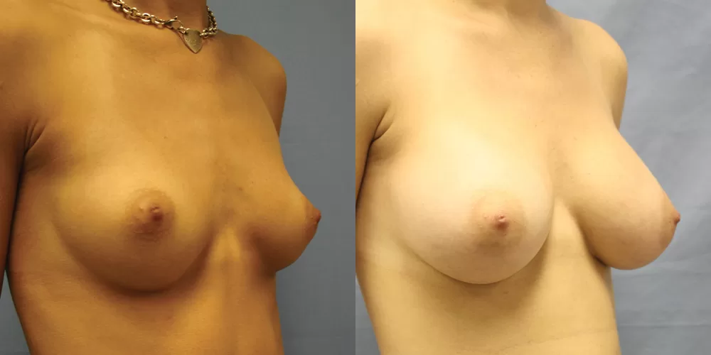 Patient 84b breast augmentation before and after