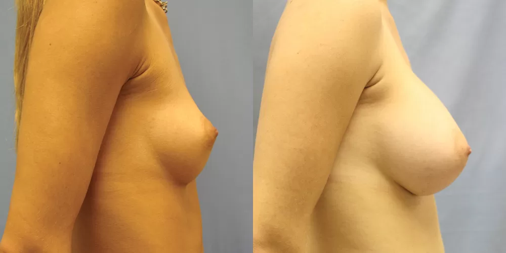 Patient 84c breast augmentation before and after