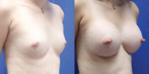 Patient 85b Breast Augmentation Before and After