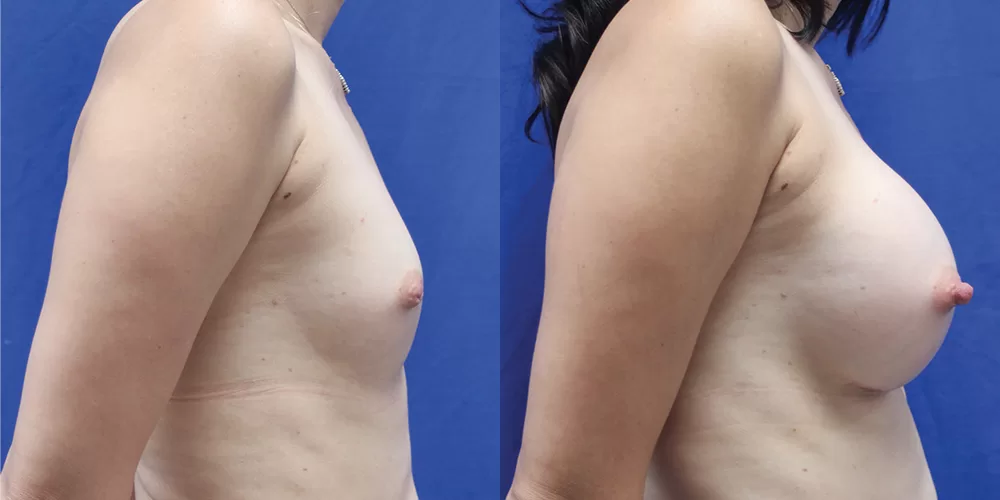 Patient 85c breast augmentation before and after
