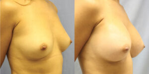 Patient 86b Breast Augmentation Before and After Right Oblique View