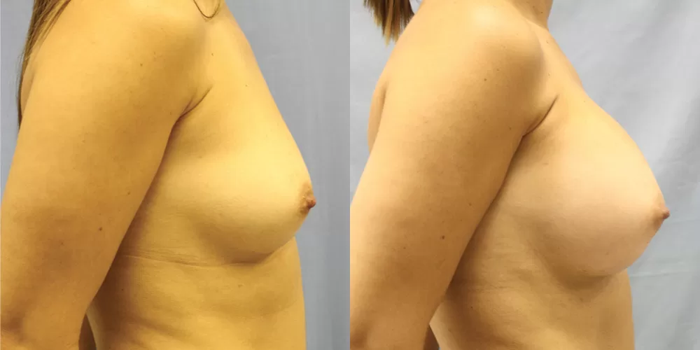 Patient 86c breast augmentation before and after right side view