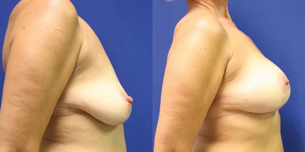 Moratis plastic surgery breast lift patient 13c