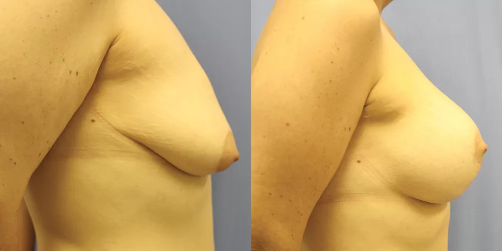 Moratis plastic surgery breast lift patient 14c