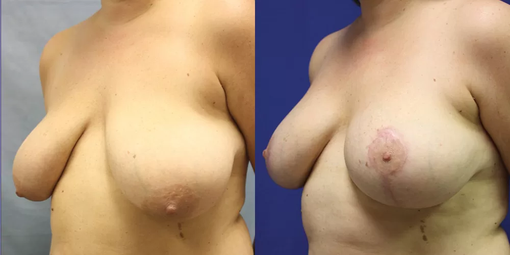 Moratis plastic surgery breast lift patient 15b