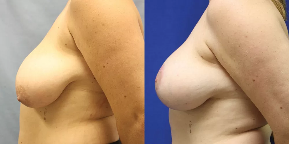 Moratis plastic surgery breast lift patient 15c