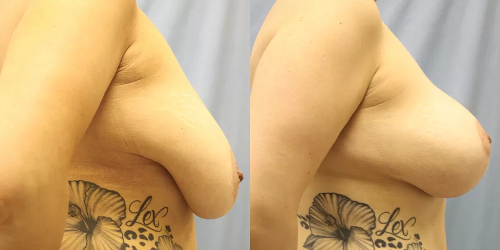 Moratis plastic surgery breast lift patient 16c