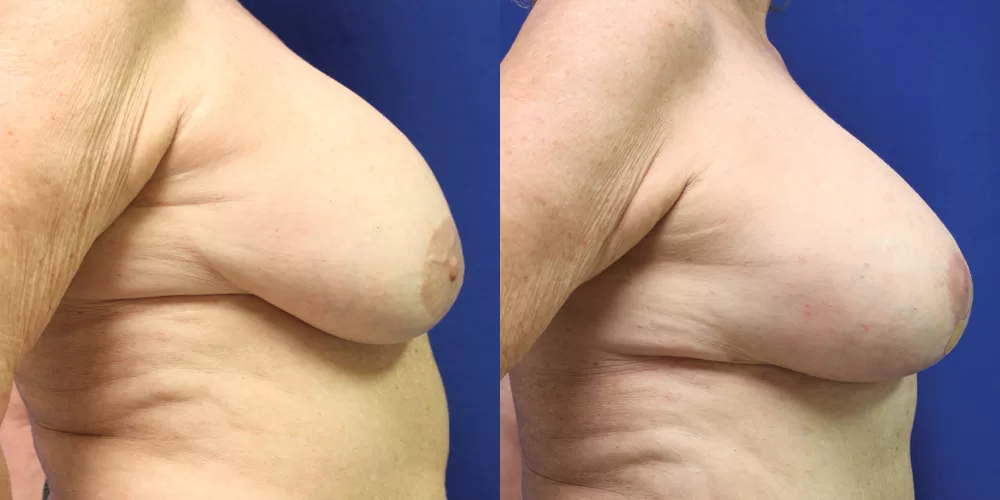 Moratis plastic surgery breast lift patient 17c