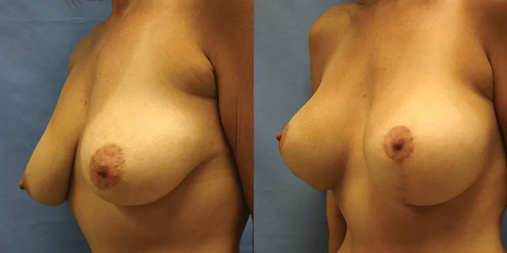 Moratis plastic surgery breast lift patient 18b
