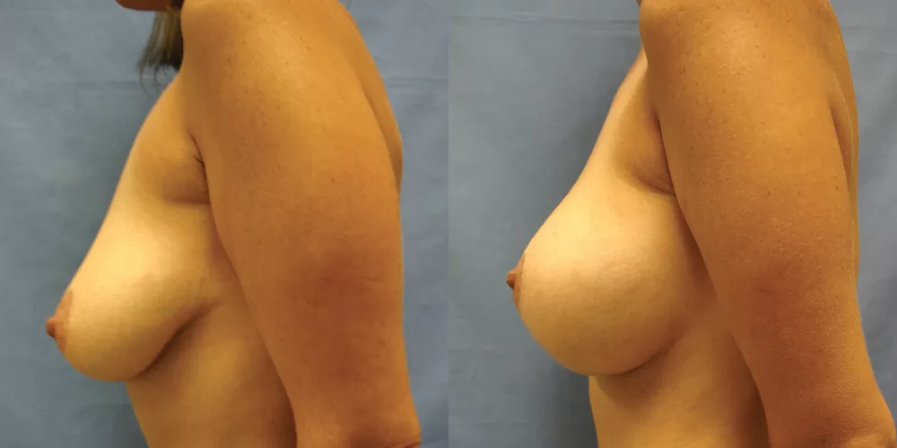 Moratis plastic surgery breast lift patient 18c