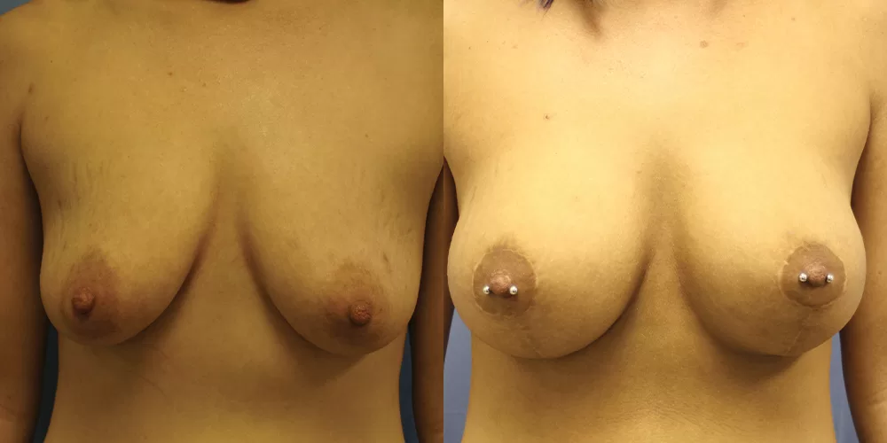 Moratis plastic surgery breast lift patient 20a