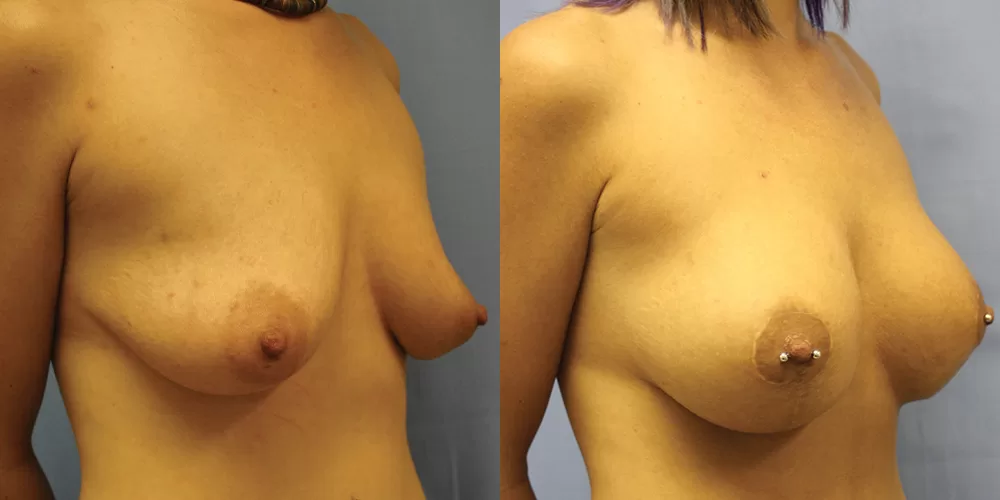 Moratis plastic surgery breast lift patient 20b