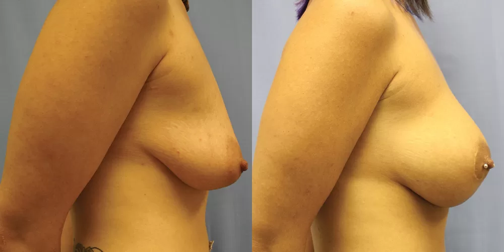Moratis plastic surgery breast lift patient 20c