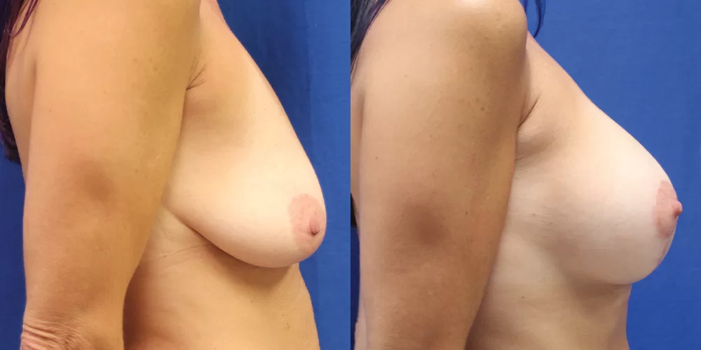 Moratis plastic surgery breast lift patient 21c