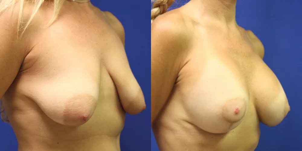 Moratis plastic surgery breast lift patient 23b