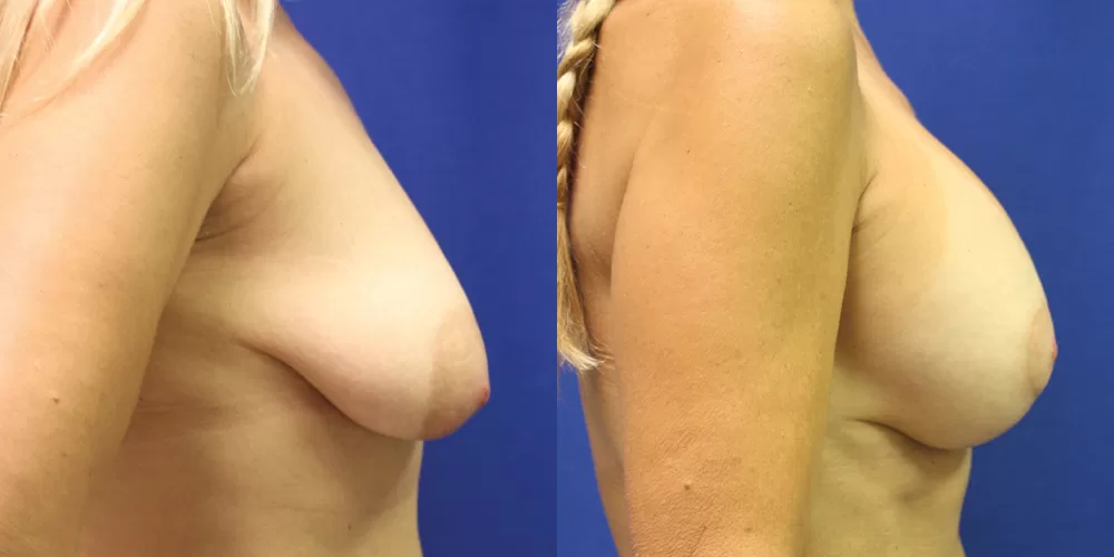 Moratis plastic surgery breast lift patient 23c