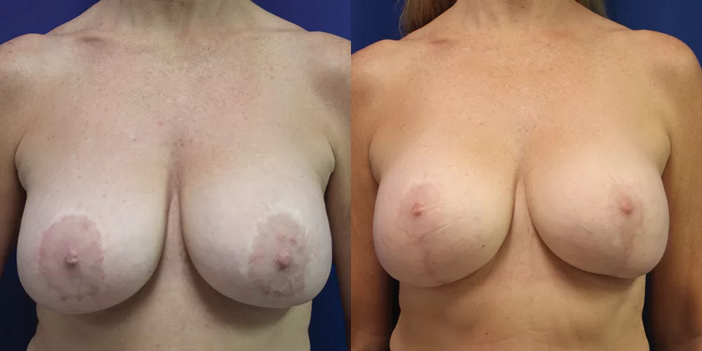 Moratis plastic surgery breast lift patient 24a