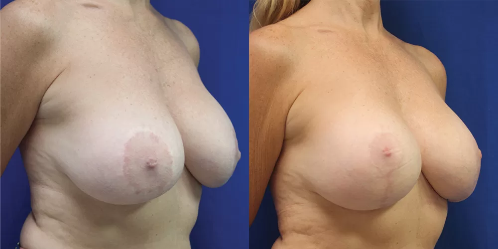 Moratis plastic surgery breast lift patient 24b