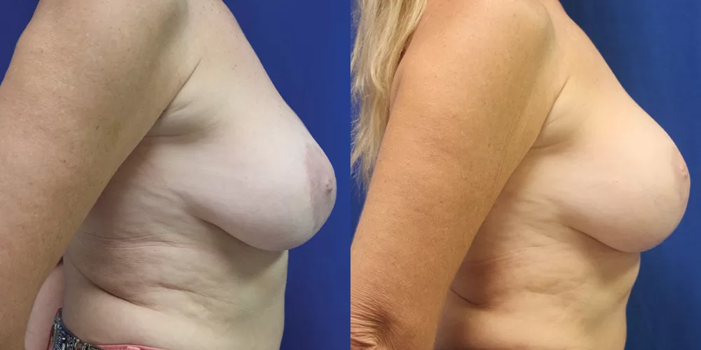 Moratis plastic surgery breast lift patient 24c