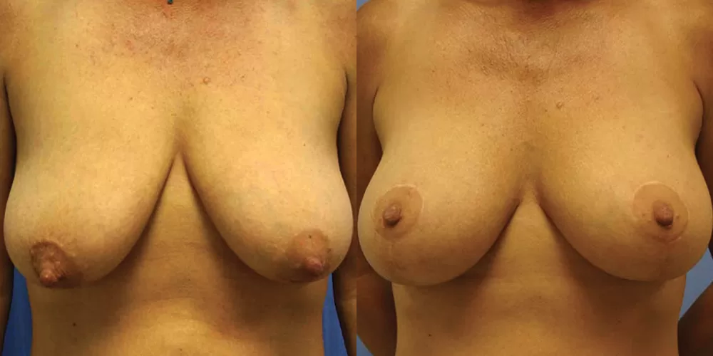 Moratis plastic surgery breast lift patient 25a