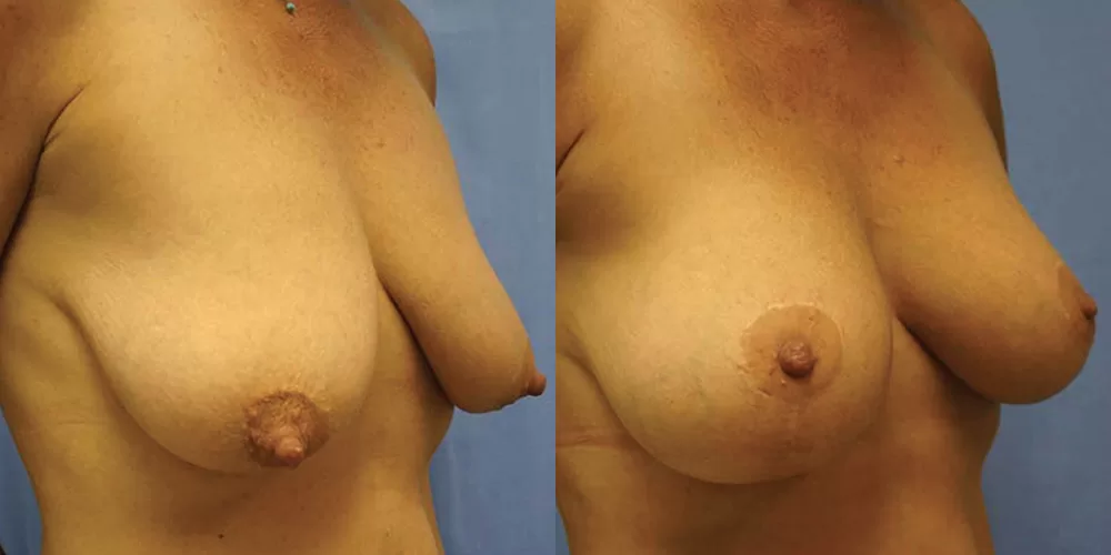 Moratis plastic surgery breast lift patient 25b