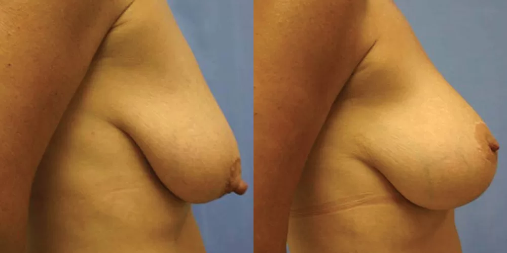 Moratis plastic surgery breast lift patient 25c