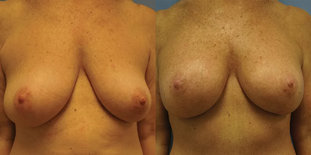 Moratis plastic surgery breast lift patient 26a