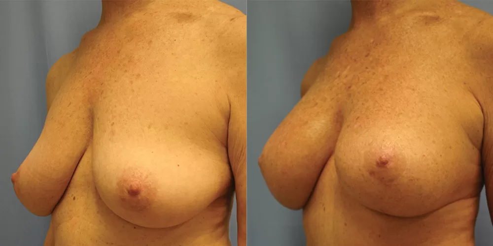 Moratis plastic surgery breast lift patient 26b