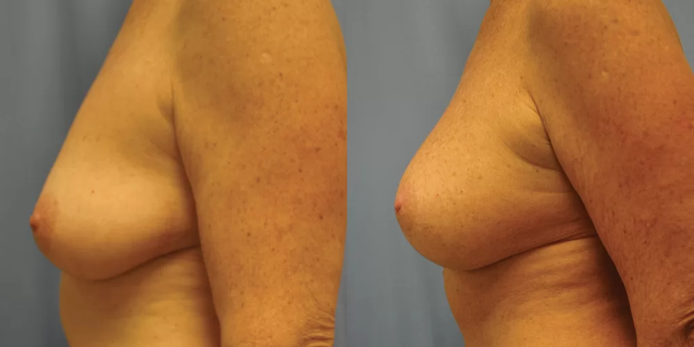 Moratis plastic surgery breast lift patient 26c